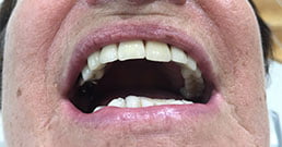 dental implants review
