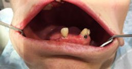 dental implant reviews