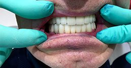 dental implants before and after