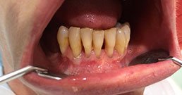 Dental implants abroad reviews Dental implants abroad reviews