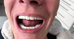 Hungary dental implants Hungary dental implants